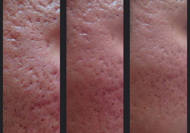 C&aacute;ch trị sẹo rỗ: C&aacute;c phương ph&aacute;p v&agrave; lựa chọn ph&ugrave; hợp từng loại sẹo