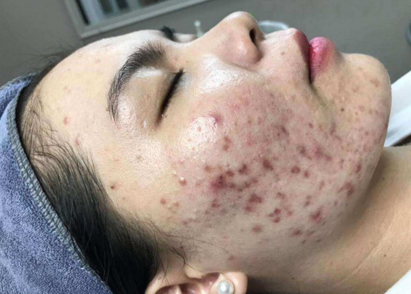 C&aacute;ch trị sẹo rỗ: C&aacute;c phương ph&aacute;p v&agrave; lựa chọn ph&ugrave; hợp từng loại sẹo