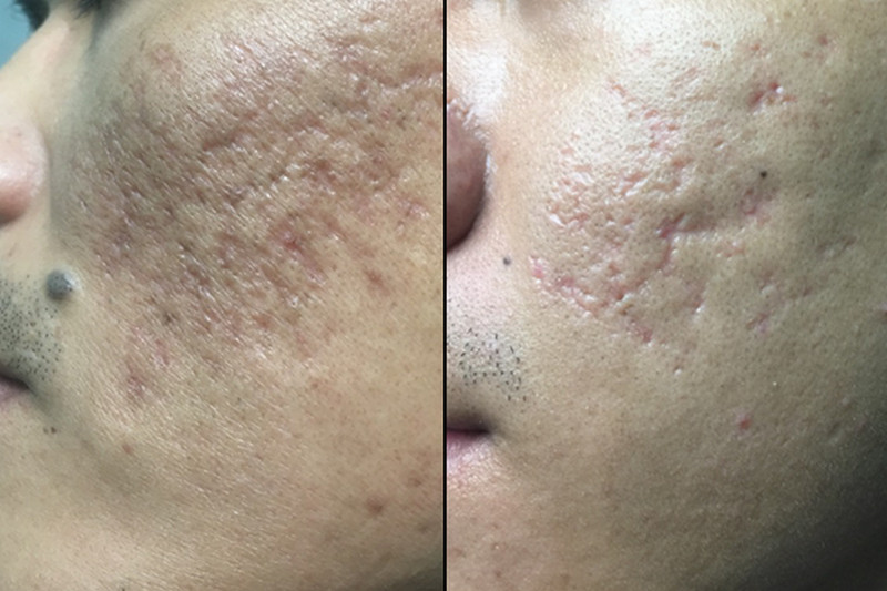 c&aacute;ch trị sẹo rỗ tr&ecirc;n mặt