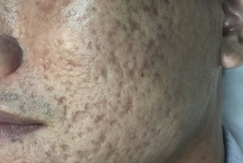 c&aacute;ch trị sẹo rỗ tr&ecirc;n mặt