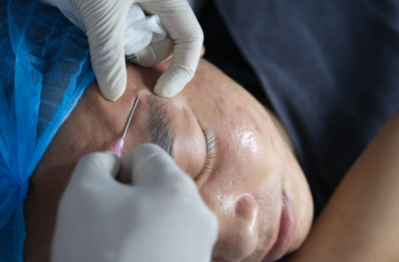 Điều trị sẹo rỗ l&acirc;u năm: Phương ph&aacute;p n&agrave;o hiệu quả nhất hiện nay?&nbsp;