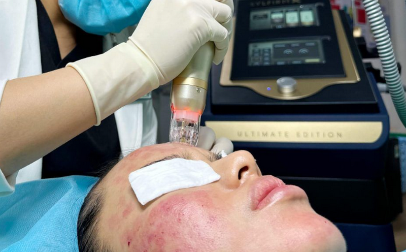 Điều trị sẹo rỗ l&acirc;u năm: Phương ph&aacute;p n&agrave;o hiệu quả nhất hiện nay?&nbsp;