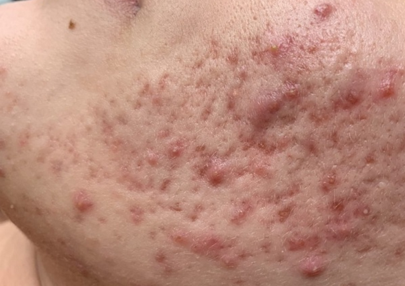 Điều trị sẹo rỗ l&acirc;u năm: Phương ph&aacute;p n&agrave;o hiệu quả nhất hiện nay?&nbsp;
