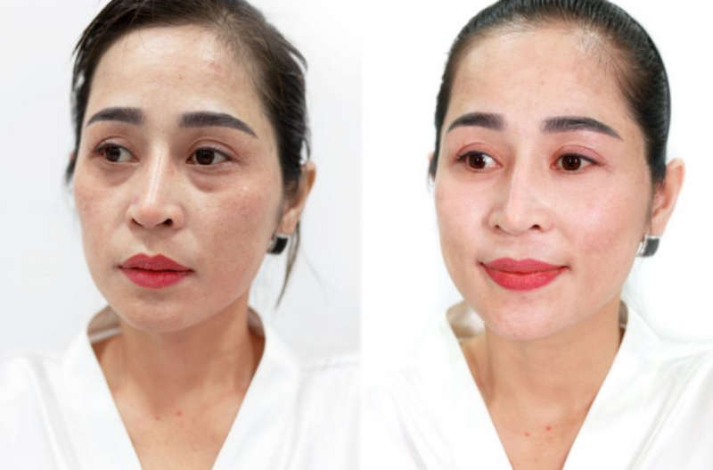 Nám là gì? Nguyên nhân, phân loại và phương pháp điều trị hiệu quả