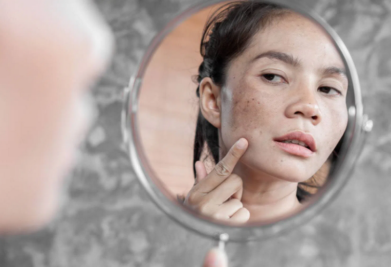 Nám là gì? Nguyên nhân, phân loại và phương pháp điều trị hiệu quả