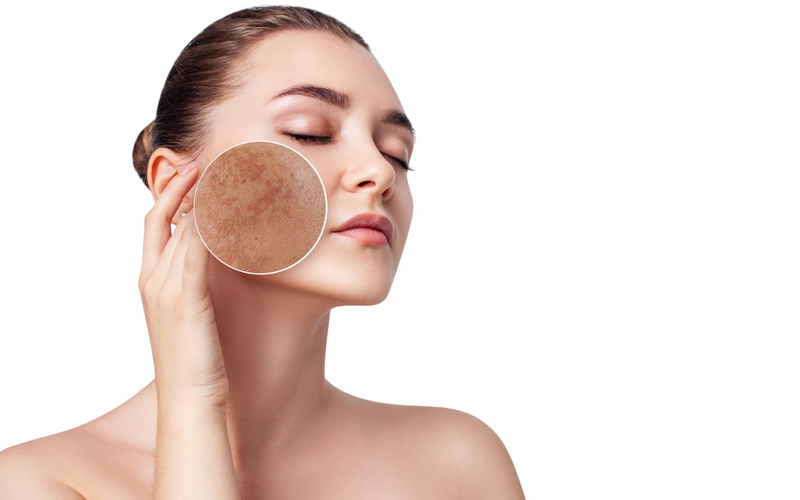Các phương pháp trị nám hiệu quả nhất và phù hợp từng loại nám