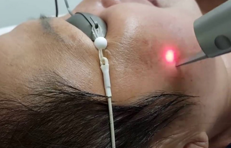 Các phương pháp trị nám hiệu quả nhất và phù hợp từng loại nám