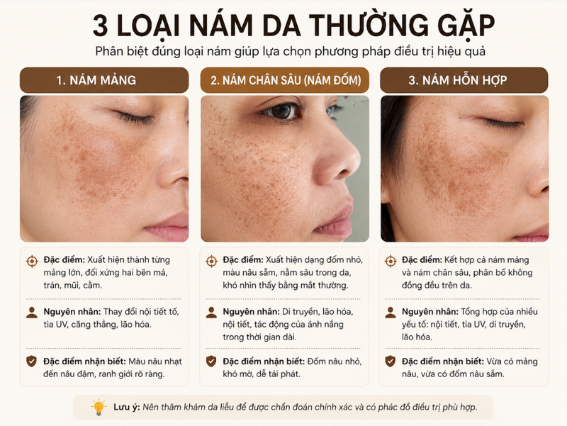 Các phương pháp trị nám hiệu quả nhất và phù hợp từng loại nám