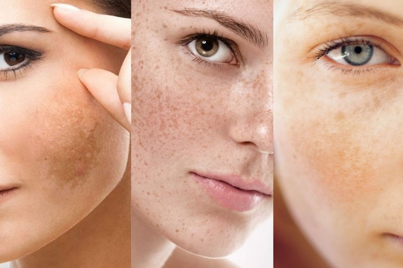 Cách trị nám từ bên trong hiệu quả và khoa học hiện nay