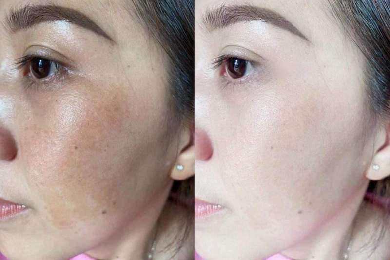 7 phương pháp điều trị nám hiệu quả nhất hiện nay