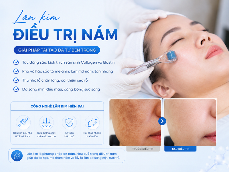 7 phương pháp điều trị nám hiệu quả nhất hiện nay