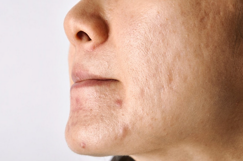 Sẹo rỗ nhẹ có tự hết không?