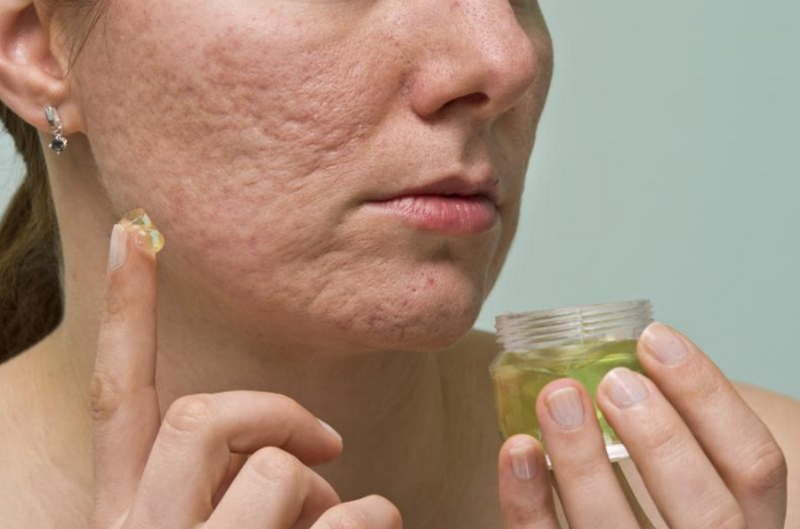 Sẹo rỗ nhẹ có tự hết không? Nguyên nhân và cách điều trị hiệu quả 