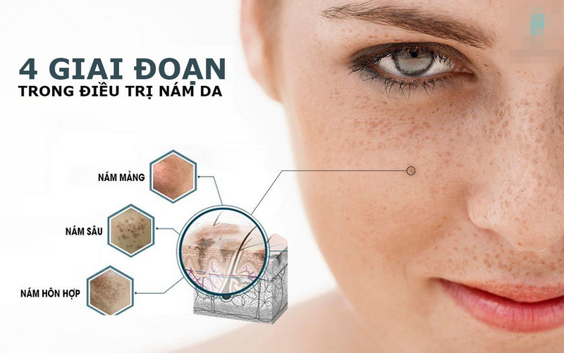 Mặt nạ trị nám tại nhà có hiệu quả? Cách chọn loại phù hợp cho từng làn da