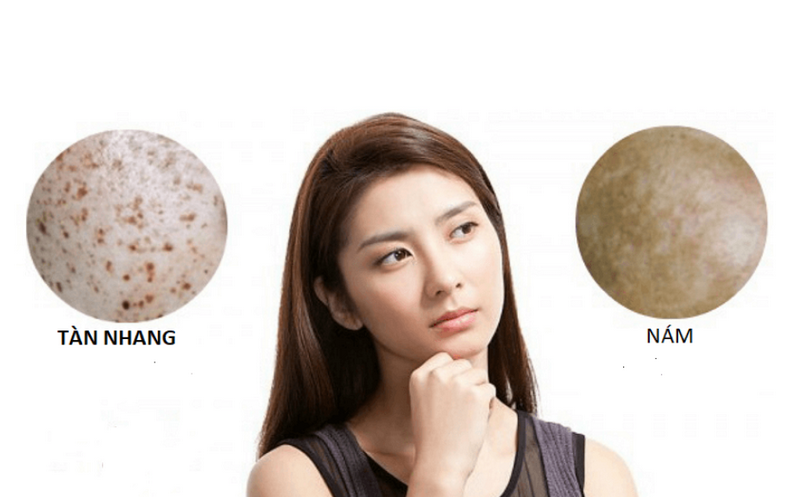 Nám tàn nhang khác nhau thế nào? Cách nhận biết và điều trị phù hợp