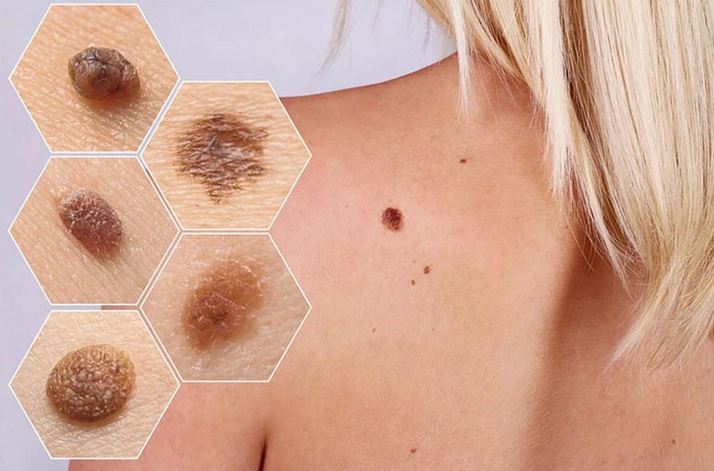 Da nổi đốm nâu ngứa là bệnh gì?