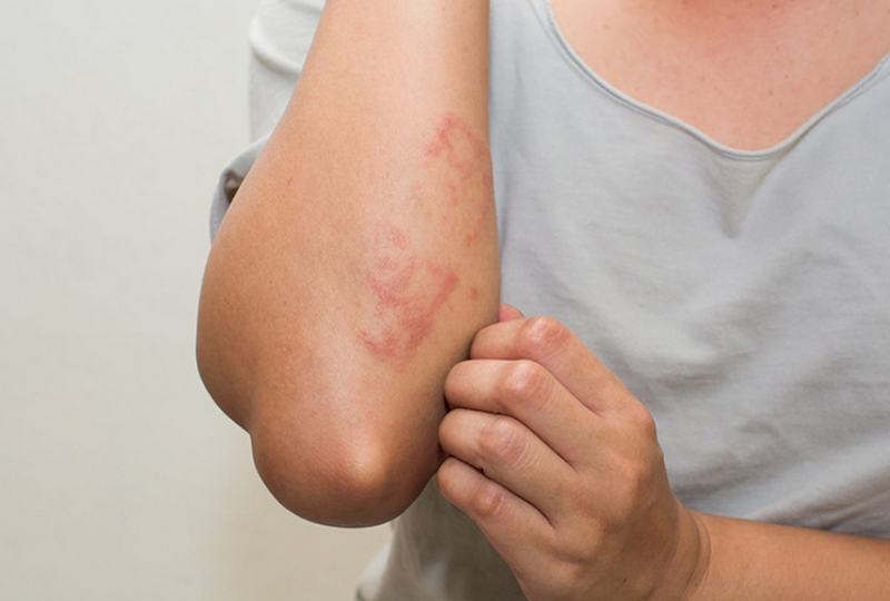 Da nổi đốm nâu ngứa là bệnh gì?