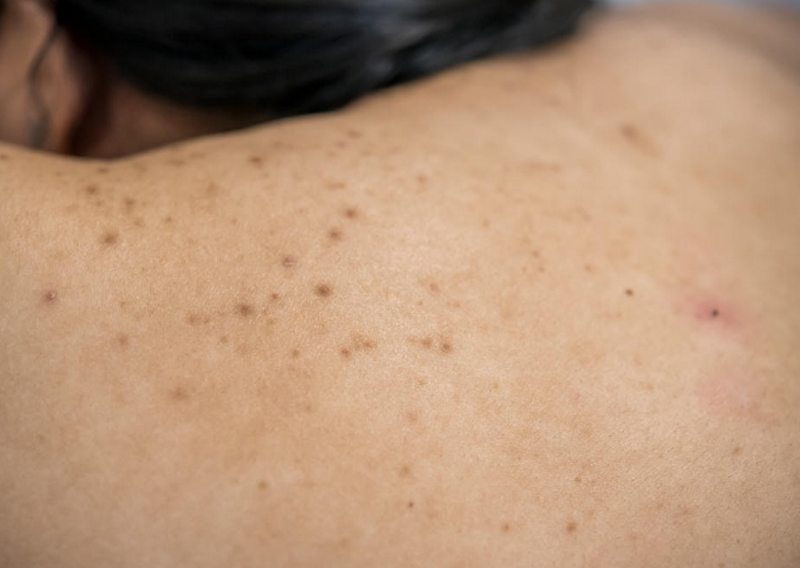 Da nổi đốm nâu ngứa là bệnh gì? 10 nguyên nhân và cách xử lý