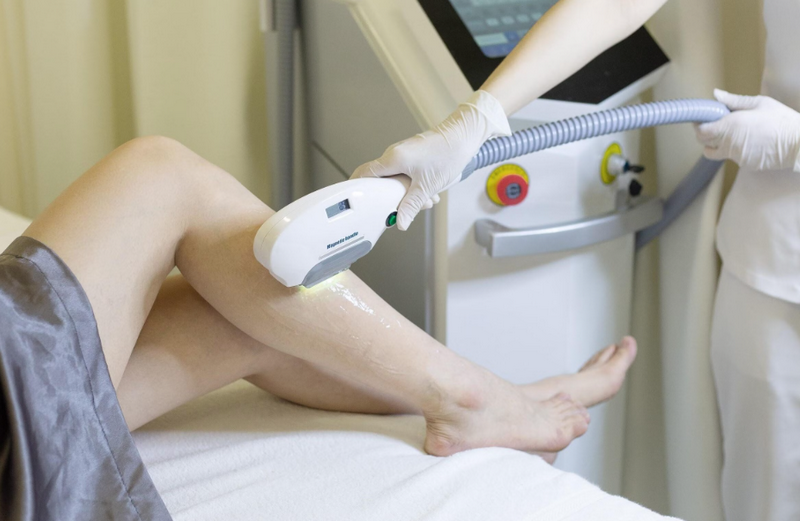 Da chân bị đốm nâu điều trị bằng laser