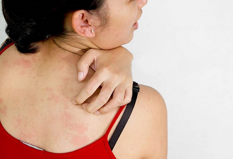 Xuất hiện đốm nâu trên da lưng là bệnh gì?