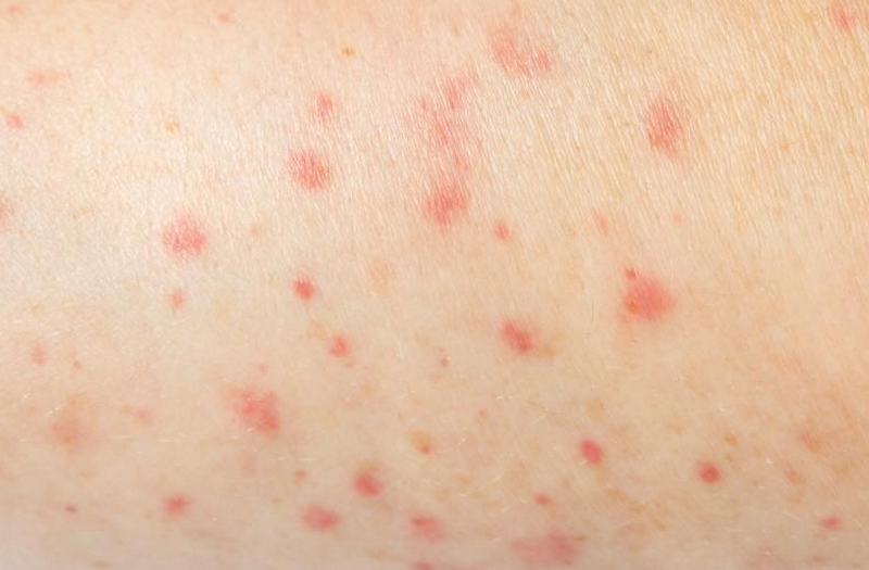 Nổi chấm đỏ trên da và ngứa là dấu hiệu bệnh gì?