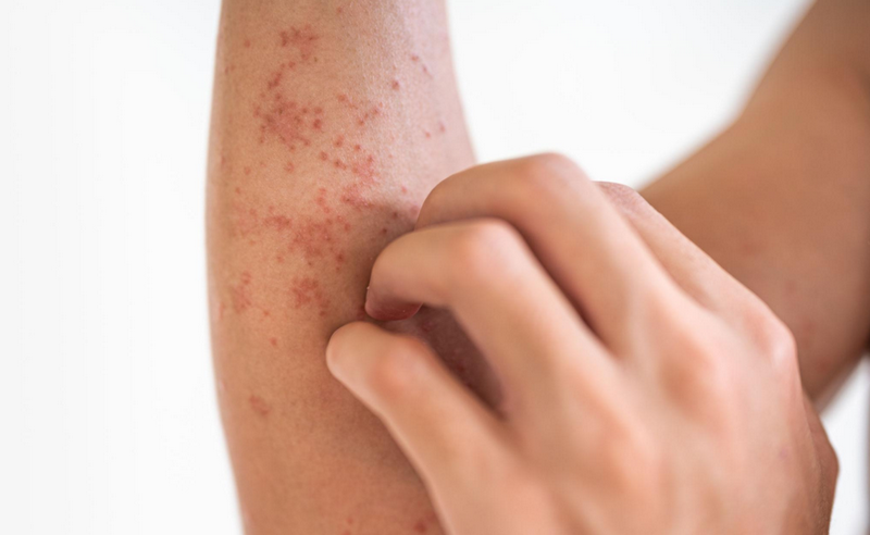 Nổi chấm đỏ trên da và ngứa là dấu hiệu bệnh gì? Cách xử lý