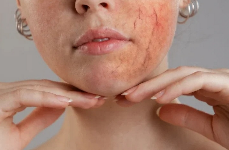 Da nổi chấm đỏ như nốt ruồi son không ngứa: Nguyên nhân, dấu hiệu cần lưu ý 