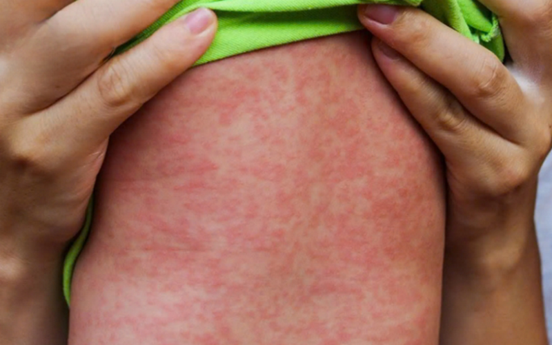 Nổi chấm đỏ trên da và ngứa là dấu hiệu bệnh gì?