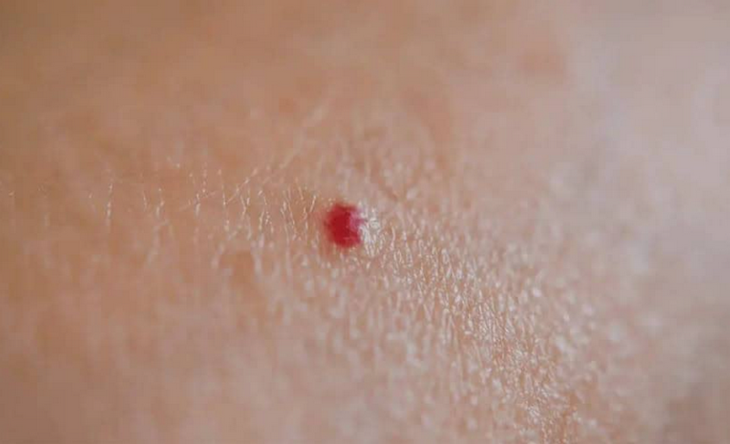 Da nổi chấm đỏ như nốt ruồi son không ngứa bị gì? Khi nào cần khám?