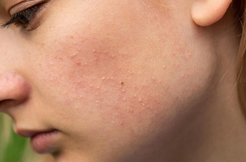 Da sần sùi mụn ẩn: Nguyên nhân & cách điều trị hiệu quả 