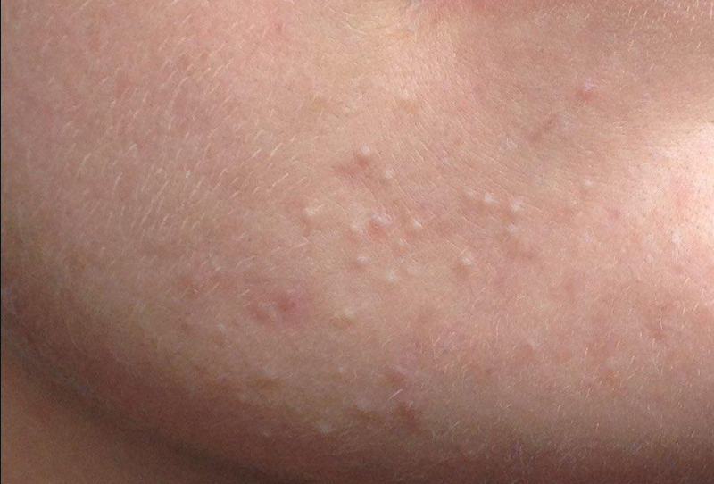 Da sần sùi mụn ẩn: Nguyên nhân & cách điều trị hiệu quả 