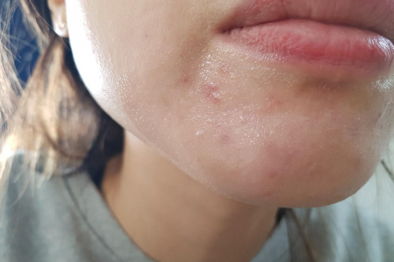 Da sần sùi mụn ẩn: Nguyên nhân & cách điều trị hiệu quả 