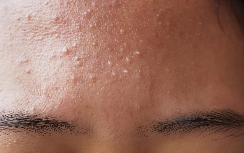Da trán bị sần sùi là mụn ẩn hay viêm da? Bác sĩ da liễu giải đáp chi tiết