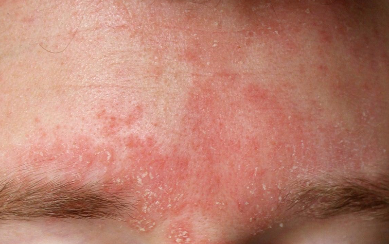 Da trán bị sần sùi là mụn ẩn hay viêm da? Bác sĩ da liễu giải đáp chi tiết