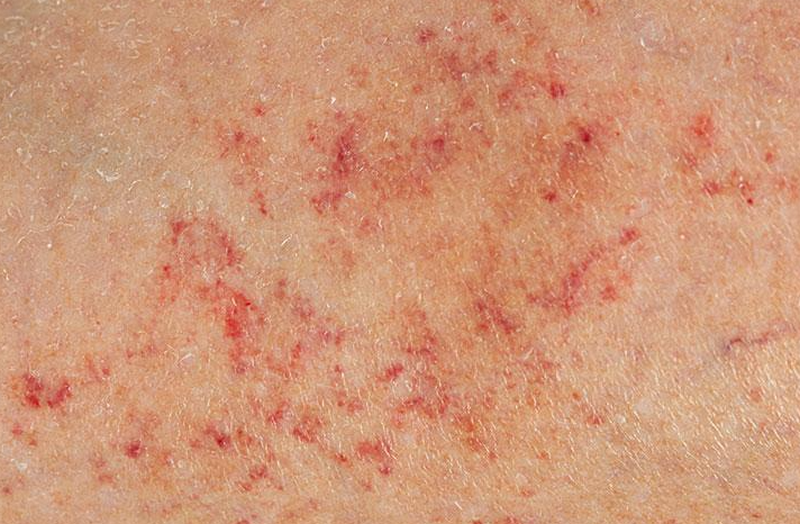 Nổi chấm đỏ trên da như nốt ruồi son là gì? Nguyên nhân, dấu hiệu nguy hiểm và cách xử lý 