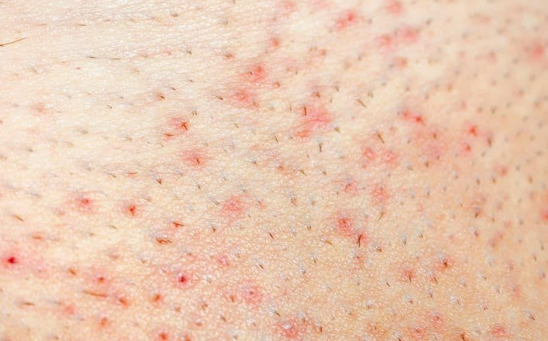 Da sần sùi là bệnh gì? 7 nguyên nhân thường gặp và cách khắc phục hiệu quả