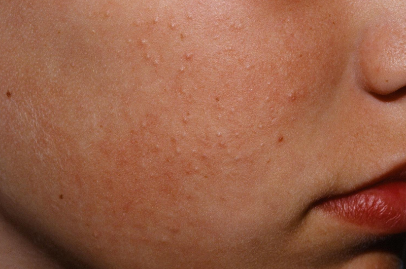 Da mặt sần sùi không mịn màng do đâu? Bác sĩ giải đáp 