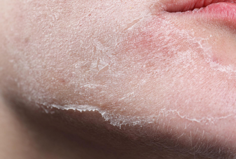 Da mặt sần sùi không mịn màng do đâu? Bác sĩ giải đáp 