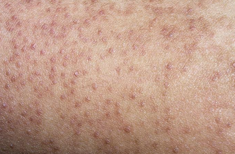 Da mông sần sùi thâm đen do khô, thiếu ẩm