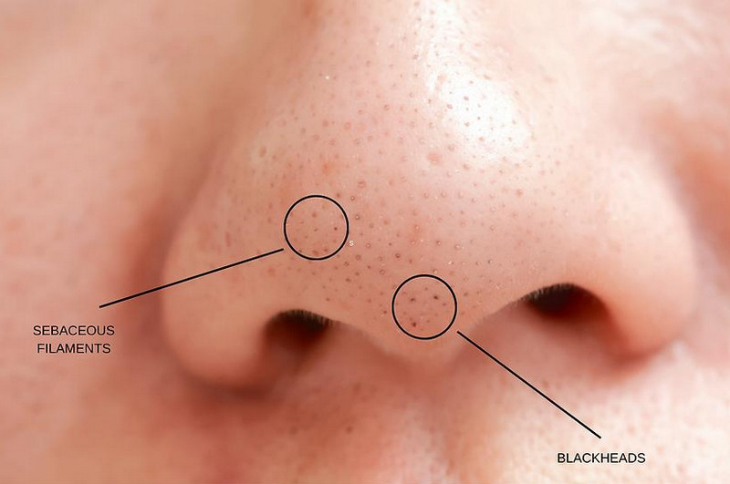 Sợi bã nhờn là gì? Cách phân biệt với mụn đầu đen và hướng xử lý đúng