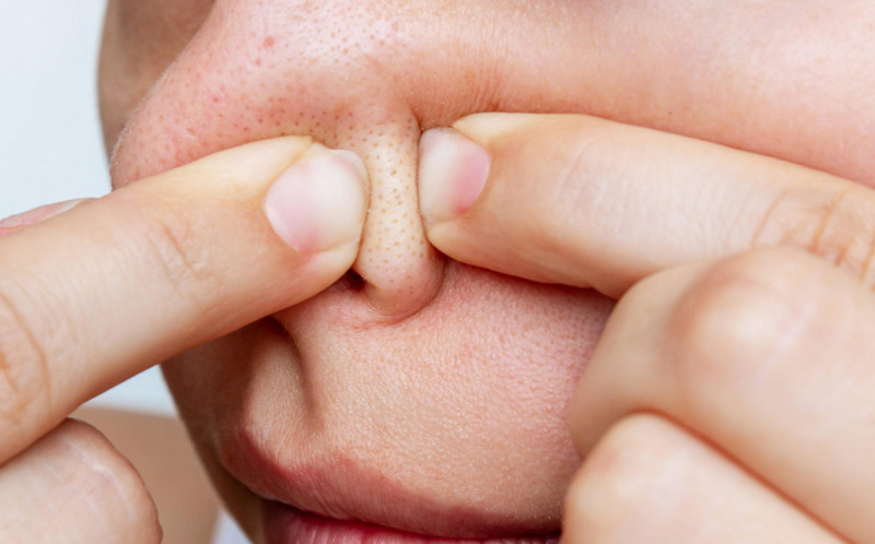Sợi bã nhờn ở mũi có hết được không? 