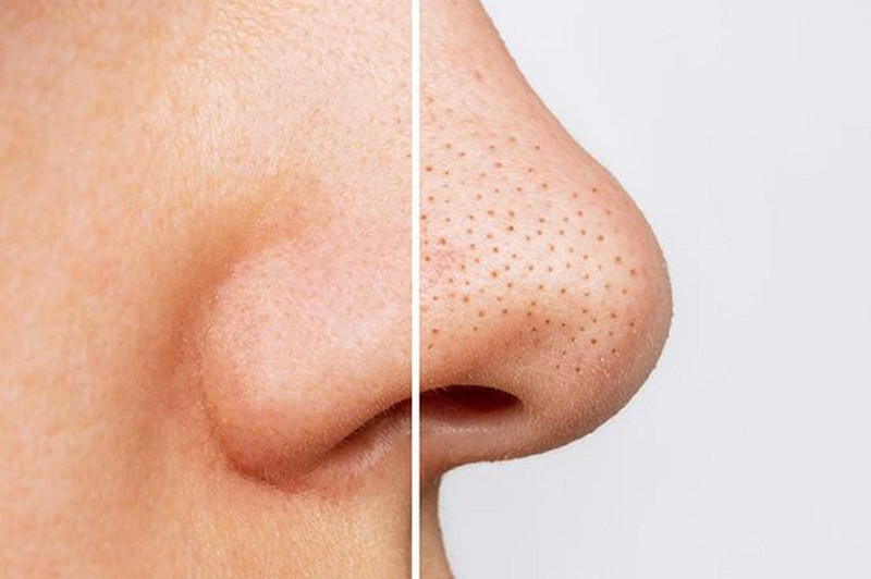 Sợi bã nhờn ở mũi có hết được không? Cách trị & ngăn chặn tái phát