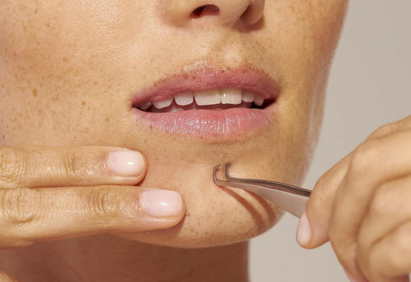 Sợi bã nhờn ở cằm có nên nặn không? Cách xử lý an toàn