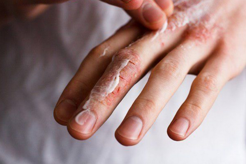 Da khô nứt nẻ: Nguyên nhân thường gặp và cách phục hồi da hiệu quả