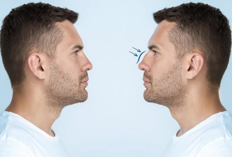Mũi tẹt là gì? Đặc điểm, nguyên nhân và cách cải thiện phù hợp