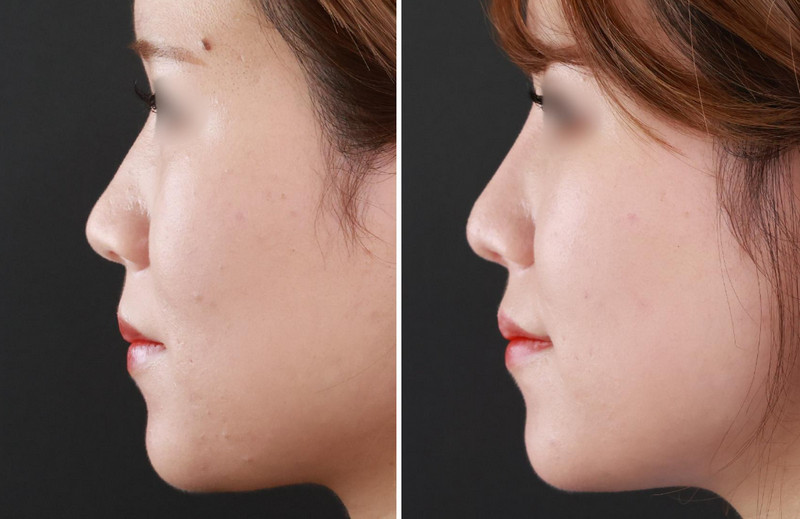 Mũi cao và mũi tẹt khác nhau thế nào? Tiêu chí đánh giá dáng mũi đẹp