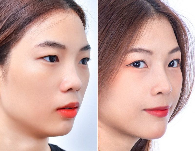 Cách làm mũi cao tự nhiên, không phẫu thuật