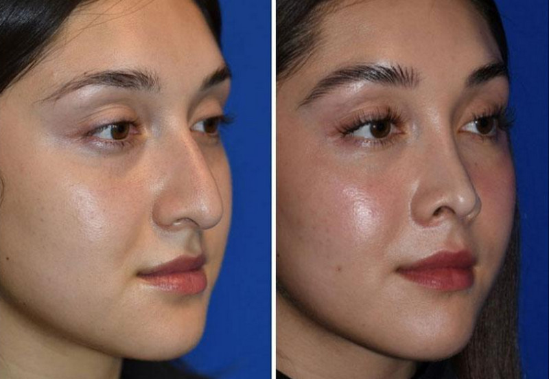 Mũi tẹt có xấu không? Đánh giá theo tỷ lệ và tổng thể khuôn mặt