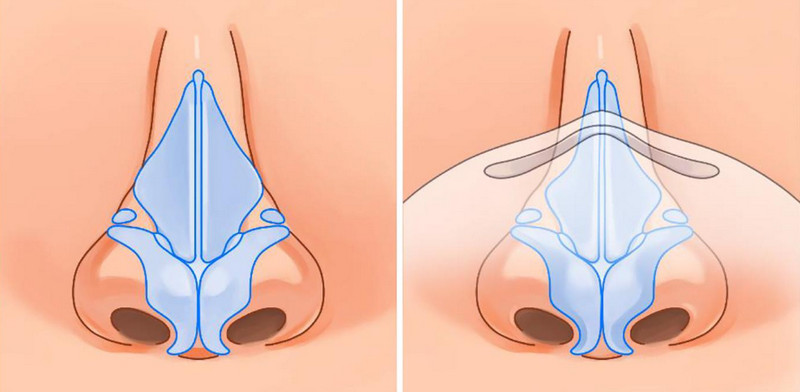 Nâng mũi cấu trúc là gì? Ưu nhược điểm, quy trình, chi phí và ai phù hợp 