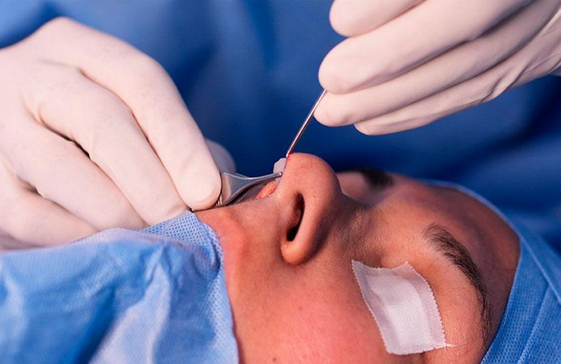 Nâng mũi cấu trúc giá bao nhiêu? Bảng giá tham khảo và các khoản cần biết 